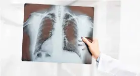  ?? /SHUTTERSTO­CK ?? Los índices de enfermedad pulmonar crónica, por ejemplo en Estados Unidos, están aumentando.