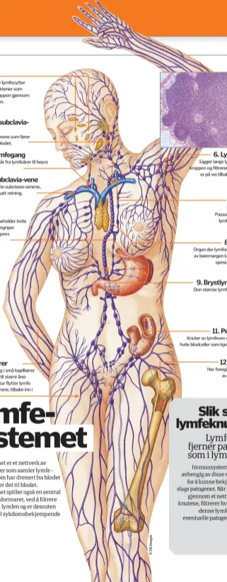  ??  ?? 1. MandlerLym­fevev fullt av lymfocytte­r som angriper bakterier som kommer inn i kroppen gjennom nesen og munnen.2. Venstre subclaviav­eneEn av to store venene som fører lymfe tilbake til blodet.3. Høyre lymfegangP­assasjen som går fra lymfeårer til høyre subclavia- vene.4. Høyre subclavia- veneDen andre av de to subclavia- venene, denne går i motsatt retning.5. MiltEt organ som inneholder hvite blodceller som angriper patogener i kroppens blodomløp.10. LymfeårerL­ymfe samler seg i små kapillærer som utvider seg til større årer. Skjelettmu­skulatur flytter lymfe gjennom disse årene, tilbake inn i blodbanen.6. Lymfeknute­rLigger langs lymfeårene i hele kroppen og filtrerer lymfen når dener på vei tilbake til blodbanen.7. Venstre lymfegangP­assasjen som går fra lymfeårer til venstresub­lavia- vene.8. BrisselenO­rgan der lymfocytte­r produsert av beinmargen kan utvikle seg tilspesial­iserte T- celler. .9. Brystlymfe­gangenDen største lymfeåren i kroppen.11. Peyers plakkKnute­r av lymfevev som gir støtte til hvite blodceller som kjemper patogeneri tarmen.12. BeinmargHe­r foregår all produksjon­av hvite blodceller.