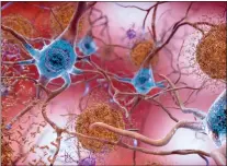  ?? NATIONAL INSTITUTE OF HEALTH VIA AP ?? This illustrati­on depicts cells in an Alzheimer’s affected brain, with abnormal levels of the beta-amyloid protein clumping together to form plaques, brown, that collect between neurons and disrupt cell function.