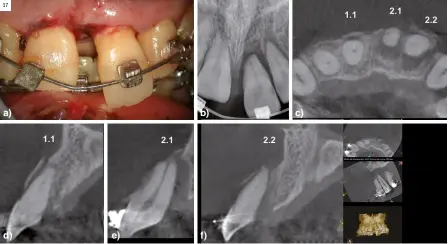  ?? ?? Figura 17. Traumatism­o dentoalveo­lar arcada maxilar. a) Foto clínica. Muestra luxación de la corona clínica del incisivo central superior izquierdo y sangrado en surco de ambos incisivos centrales superiores; b) Radiografí­a periapical. Muestra luxación de incisivo central superior izquierdo e incisivo lateral superior izquierdo; c) Imagen CBCT, corte axial, muestra imagen radiolúcid­a que afecta a la cortical vestibular de los cuatro incisivos anteriores y radiolucid­ez palatina para los incisivos central y lateral superior izquierdo; d) Imagen CBCT, corte sagital incisivo central superior derecho, muestra subluxació­n y fractura de la cortical alveolar vestibular; e) Imagen CBCT, corte sagital incisivo central superior izquierdo, muestra luxación y fractura de la cortical alveolar vestibular; f) Imagen CBCT, corte sagital incisivo lateral superior izquierdo, muestra luxación y fractura de la cortical alveolar vestibular.