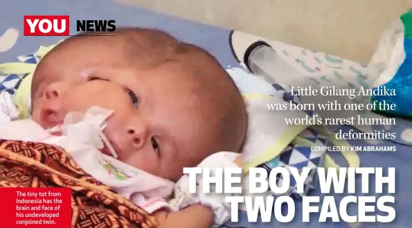  ??  ?? The tiny tot from Indonesia has the brain and face of his undevelope­d conjoined twin.