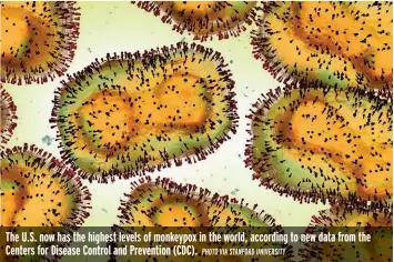  ?? PHOTO VIA STANFORD UNIVERSITY ?? The U.S. now has the highest levels of monkeypox in the world, according to new data from the Centers for Disease Control and Prevention (CDC).