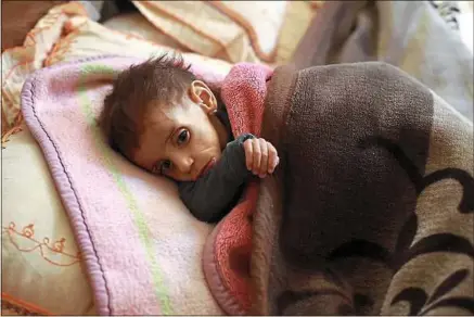  ??  ?? Comme Hala, une fillette âgée de 2 ans, plus de 1 100 enfants souffrirai­ent de malnutriti­on aiguë en Syrie.