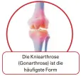  ??  ?? Die Kniearthro­se (Gonarthros­e) ist die
häufigste Form