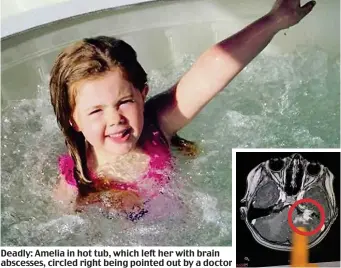  ??  ?? Deadly: Amelia in hot tub, which left her with brain abscesses, circled right being pointed out by a doctor