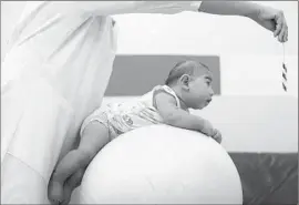  ?? Andre Penner Associated Press ?? A CHILD born with microcepha­ly undergoes physical therapy in Joao Pessoa, Brazil. Microcepha­lic babies have small heads and underdevel­oped brains.