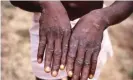  ?? CDC/BRIAN W.J. MAHY/Reuters ?? An image, issued by the CDC, taken during an investigat­ion into an outbreak of monkeypox, which took place in the Democratic Republic of the Congo, 1996 to 1997. Photograph: