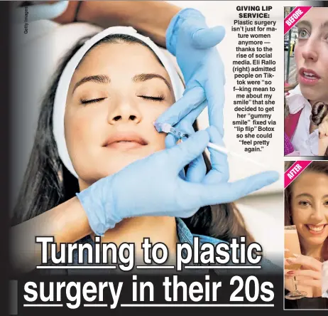  ?? ?? GIVING LIP SERVICE: Plastic surgery isn’t just for mature women anymore — thanks to the rise of social media. Eli Rallo (right) admitted people on Tiktok were “so f--king mean to me about my smile” that she decided to get her “gummy smile” fixed via “lip flip” Botox so she could “feel pretty again.”