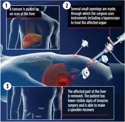  ??  ?? LIFELINE: How the new keyhole procedure is carried out by surgeons