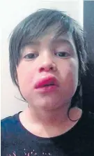  ??  ?? Wheronui Willoughby, 6, suffered a bruised and swollen upper lip