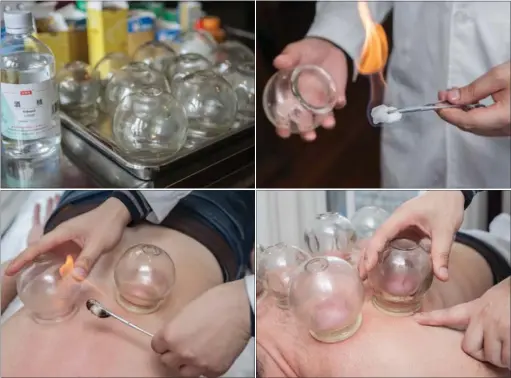  ?? PHOTOS BY LAM YIK FEI / GETTY IMAGES ?? The Chinese treatment, also known as baguan, utilizes heated glass cups to create a suction on the patient’s skin, causing a circular mark that looks like bruising on the skin.