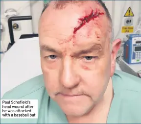  ??  ?? Paul Schofield’s head wound after he was attacked with a baseball bat
