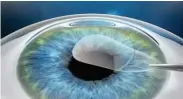  ??  ?? In the ReLex SMILE procedure, the lenticule is removed through a small incision and the disruption to the biomechani­cs of the cornea is minimal.