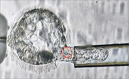  ?? ASRM VIA AP ?? This undated microscope image provided by the American Society for Reproducti­ve Medicine in January 2018 shows a trophectod­erm biopsy, in which cells from the outer layer of an embryo that develop into the placenta and amniotic membranes are removed...