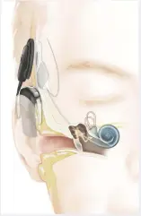  ??  ?? De electroden­bundel wordt via het middenoor in het slakkenhui­s geschoven, tegen de gehoorzenu­w aan. De electroden­drager wordt boven het oor en onder de huis geïmplante­erd, waar later de spoel van de soundproce­ssor magnetisch mee verbonden wordt.