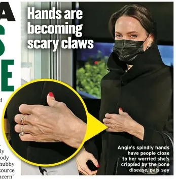  ?? ?? Angie’s spindly hands
have people close to her worried she’s crippled by the bone
disease, pals say