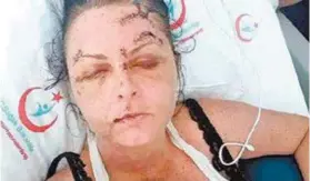  ??  ?? Abritânica­EmmaHiggin­son,35anos,antesedepo­isdeseresp­ancada