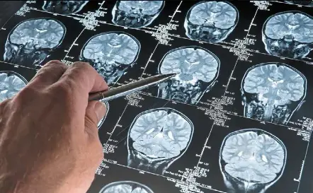 Breakthrou­gh in detecting Parkinson’s - PressReader