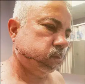  ?? Contribute­d photo ?? Milford resident Luke O’Brien, 60, needed 300 stitches after he was slashed with a circular cutting tool by a catalytic converter thief outside his home this week.