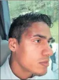  ??  ?? Varane mostró su golpe el sábado.