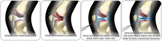  ??  ?? Pain - the red is a knee joint with painful osteo-arthritis. Arthritis causes the joint space to decrease, grinding, stiffness, decreased motion, bone spurs, swelling and a lot of pain.
Everyone Wants Proof: In the artist simulated drawings above,...