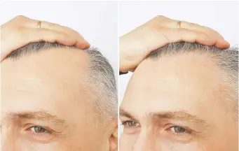  ??  ?? From cloning hair follicles to 3D printed follicle moulds, experts are plugging away at the problem of baldness.