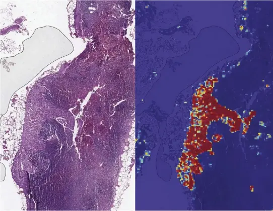  ??  ?? The AI was shown a microscope slide containing lymph nodes (left), and it was able to correctly identify the tumorous region by highlighti­ng it in red (right)