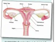  ??  ?? SURGERY: Ovarian tissue is removed and sliced into strips in a laboratory