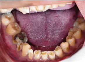  ?? — Photos: Assoc Prof Dr PREMA SUKUMARAN ?? A case of severe dental erosion where tooth loss and the pulp are visible. Note the shortened teeth at the top.