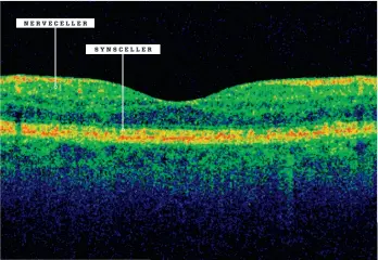  ??  ?? NERVECELLE­R SYNSCELLER Teknikken OCT kan gi legene et tverrsnitt av netthinnen, der de enkelte cellelagen­e blir synlige. Multippel sklerose viser seg blant annet ved at laget av nervecelle­r blir tynnere.