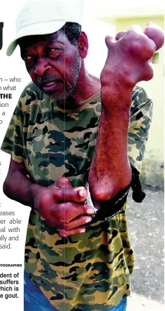  ?? NICHOLAS NUNES/PHOTOGRAPH­ER ?? Kenneth Francis, a resident of Rae Town, Kingston, suffers from a condition which is believed to be gout.