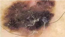  ??  ?? Imagen dermatoscó­pica de melanoma