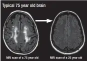  ??  ?? MRI scans show this revolution­ary “Genius Pill” reverses deteriorat­ion 28 years of deteriorat­ion due to aging and dramatical­ly improves brain health. Typical 75 year old brain MRI scan of a 75 year old MRI scan of a 25 year old