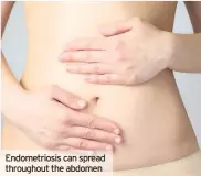  ??  ?? Endometrio­sis can spread throughout the abdomen