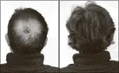  ??  ?? Breakthrou­gh research proves this discovery helps fill-in bald spots, re-nournishes thinning hair, and leads to noticeable growth in as little as 30 days.