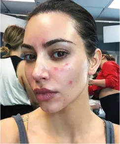  ?? ?? SORE PATCHES: Kim Kardashian showing off her psoriasis