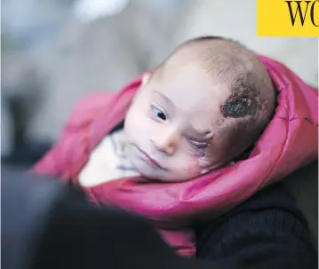  ?? AMER ALSHAMI / ANADOLU AGENCY / GETTY IMAGES ?? Three-month-old Syrian baby Karim lost his left eye, and his mother, after a government bomb attack in a market in Ghouta. Later, in another attack from Assad’s forces, shrapnel tore through his house, crushing his skull.