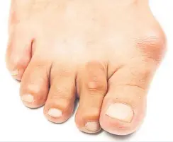  ??  ?? FOOT OF THE MATTER Bunions can cause the toe joints to become deformed