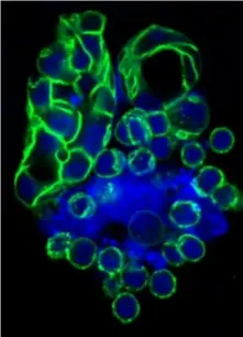  ?? Lee-Oesterreic­h Lab ?? Pitt researcher­s are studying breast cancer tumors in a lab. The green staining in this image outlines the growing cancer cells.