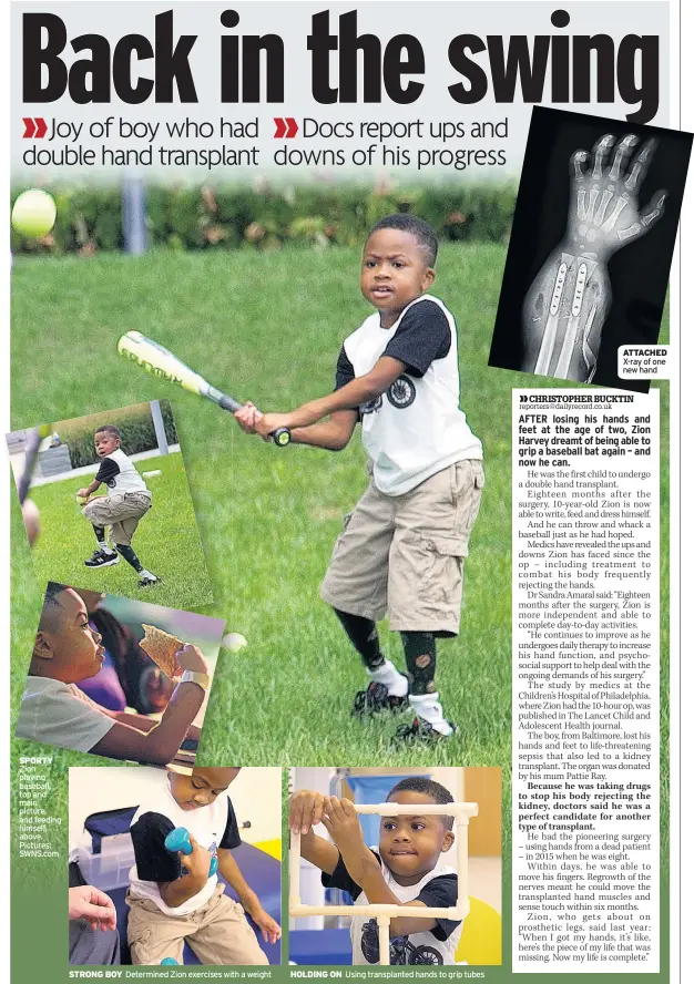  ??  ?? SPORTY Zion playing baseball, top and main picture, and feeding himself, above. Pictures: SWNS.com STRONG BOY Determined Zion exercises with a weight HOLDING ON Using transplant­ed hands to grip tubes ATTACHED X-ray of one new hand