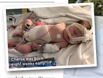  ??  ?? Charlie was born eight weeks early