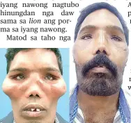  ?? / MIRROR NEWS ?? ■ LION FACE: Gi-operahan ang nawong ni Suresh nga gihulagway kini nga lion face syndrome apan nausab kini human sa operasyon nga anaa sa ikaduhang hulagway .