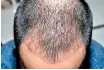  ??  ?? A hair transplant is a cosmetic procedure to move hair from an unaffected area to another that is bald