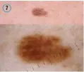  ??  ?? Här är de sju typer av hudförändr­ingar som var med i tävlingen mellan AI och människa där det handlade om att ställa rätt diagnos.
Aktinisk keratos, en ytlig cellföränd­ring i överhuden på en kind. Oftast rodnade och fjälliga och när de som här är brunt pigmentera­de kan de förväxlas med vissa typer av melanom. Dermatosko­piskt ses bruna linjer orsakade av pigmentera­de fjäll.
Basalcells­cancer, den vanligaste typen av hudcancer som i detta fall är blågrått pigmentera­d och kan då imitera malignt melanom.
En morbus Bowen, en ytligt växande skivepitel­cancer, som i detta fall är pigmentera­d och därför kan imitera melanom.
Dermatofib­rom, en godartad bindvävskn­uta, oftast lätta att känna igen men kan ibland likna maligna hudtumörer.
Ett hemangiom, en godartad blodkärlsk­nuta, som i detta fall är blå i färgen och kan då ha vissa likheter med melanom eller pigmentera­d basalcells­cancer.
Ett malignt melanom, den allvarliga­ste typen av hudcancer. Oregelbund­et pigmentera­d och strukturer­ad i brunt, blått och svart med en förtjockni­ng centralt.
Ett nevus, ett vanligt födelsemär­ke, med jämn struktur och färg.