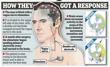  ??  ?? Double-coil electrode Vagus nerve Stimulator