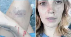  ?? /INSTAGRAM ?? La colombiana se encontraba grabando novela y parte del edificio se derrumbó, causándole hematomas.