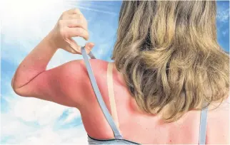  ?? 123RF STOCK ?? A sunburn can occur in less than 15 minutes when no preventati­ve measures are taken to protect the skin.