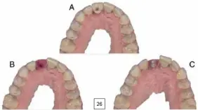  ??  ?? 26 24. Modelos digitales de la arcada dental maxilar obtenida mediante escaneado intraoral a color (A) y su modelo virtual correspond­iente (B). 25. Scanbody para modelo digital intraoral atornillad­o intraoralm­ente a su implante correspond­iente. 26. Escaneado múltiple para modelo óptico digital en presencia de trayecto periimplan­tario transmucos­o condiciona­do mediante prótesis provisiona­l atornillad­a: escáner del provisiona­l en su asiento (A), escáner del trayecto transmucos­o (B) y escáner del scanbody (C).