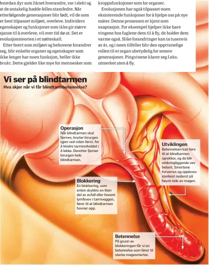  ??  ?? Vi ser på blindtarme­n
Operasjon
Når blindtarme­n skal fjernes, knyter kirurgen igjen ved roten først, for å hindre tarminnhol­det i å lekke. Deretter fjerner kirurgen hele blindtarme­n.
Blokkering
En blokkering, som enten skyldes en liten del av...