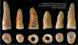  ??  ?? Penyebab utama karies di masa lalu adalah jenis makanan dan pola hidup masyarakat.